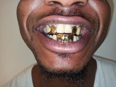 Yellow Gold 18 Karrat VVS Diamonds
Grillz 
custom Grillz