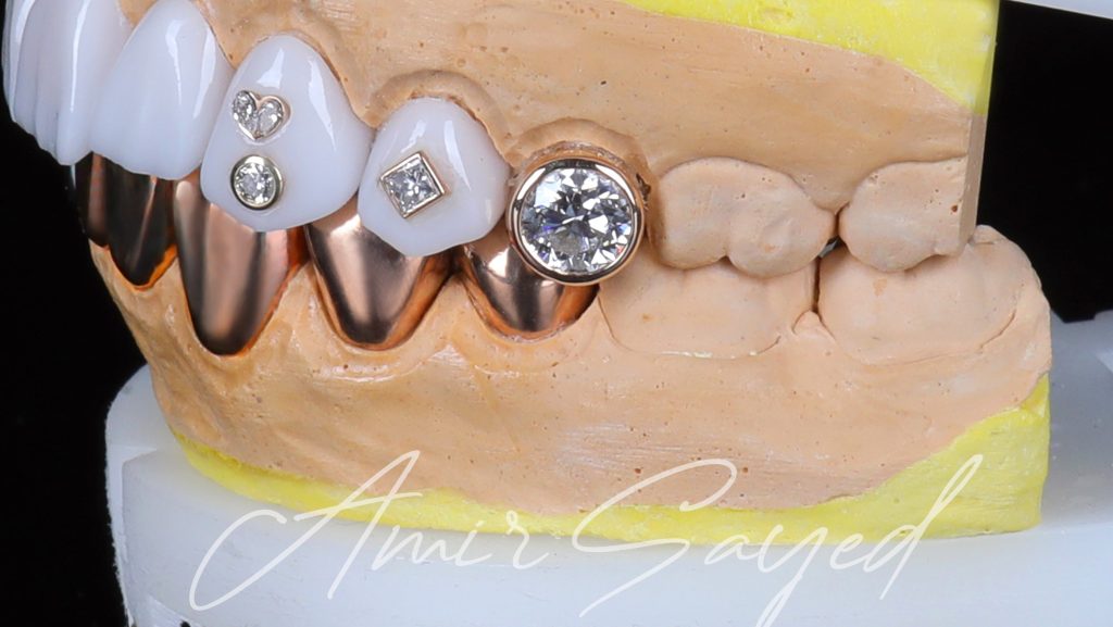 Diamond veneers