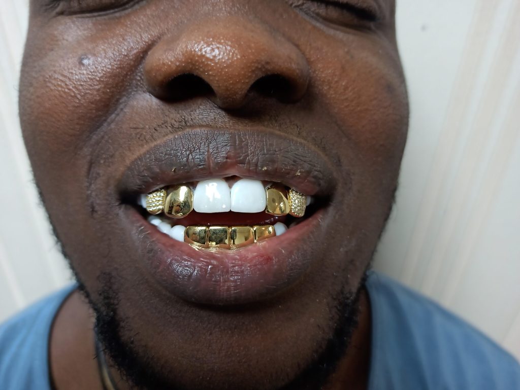 Veneers and gold teeth