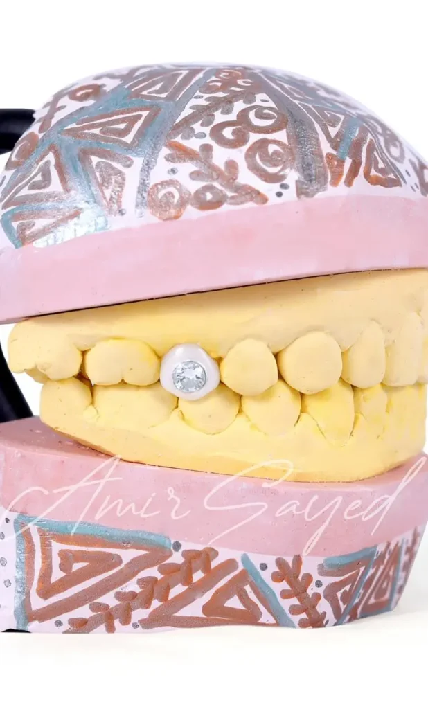 difference between veneers and diamond veneers 