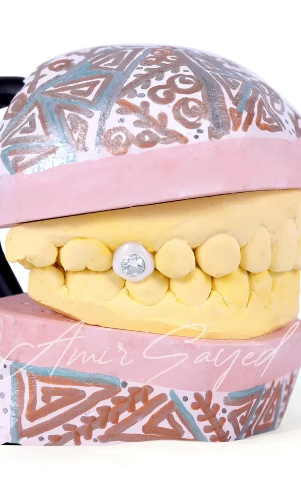 Veneers and Diamond veneers