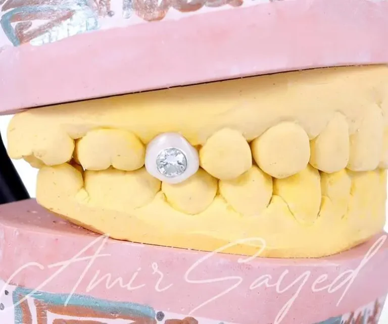 Discover the best in luxury cosmetic dentistry at Grillz and Teeth in Dubai. Get a celebrity smile makeover, custom diamond veneers, gold teeth, and more for the ultimate smile transformation. Achieve the best diamond veneers and a million-dollar smile today. Permanent Diamond Teeth