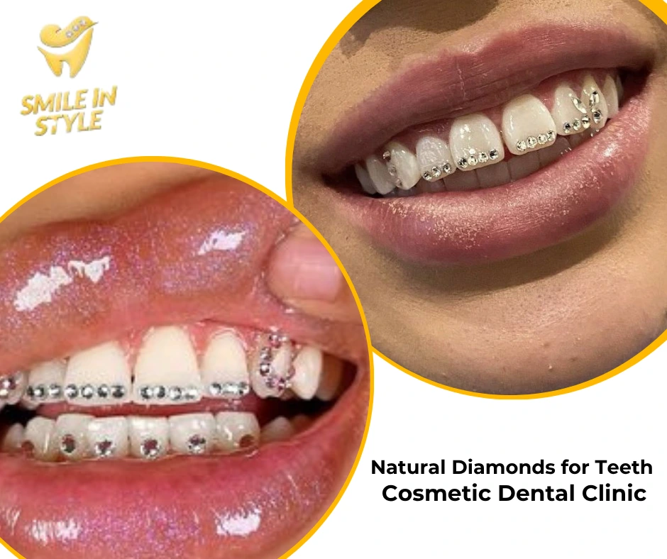 CVD vs Natural Diamonds for Teeth