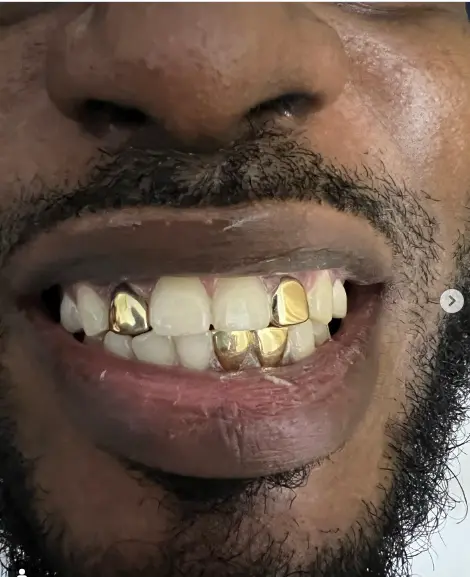 Fixed vs Removable Grillz What’s the Best Choice for You?