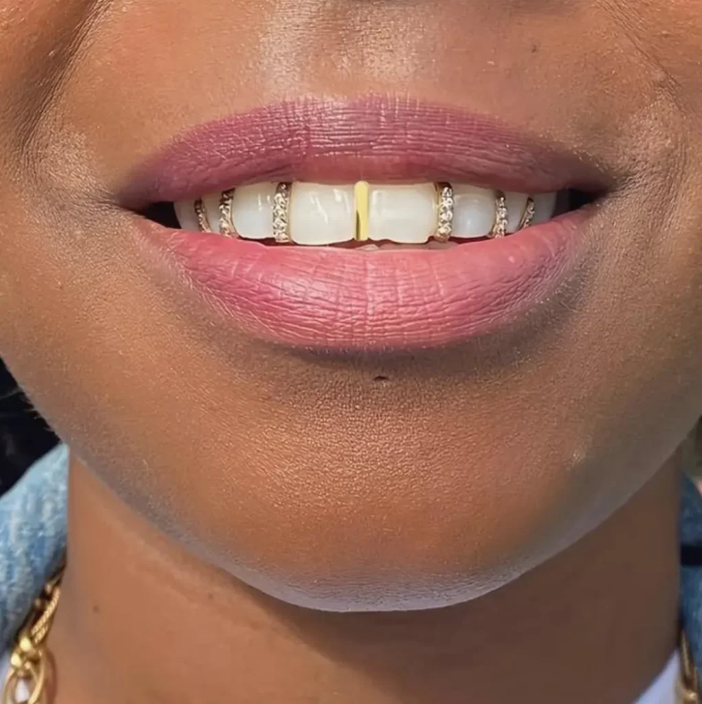 Fixed vs Removable Grillz What’s the Best Choice for You?