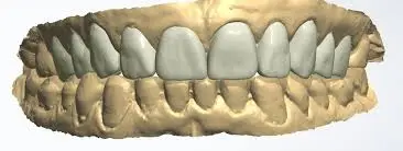 Custom Grillz Process