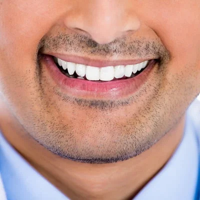 Veneers Teeth