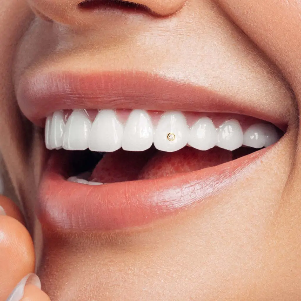 diamond veneers teeth