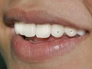 diamond veneers teeth