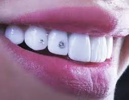 diamond veneers teeth