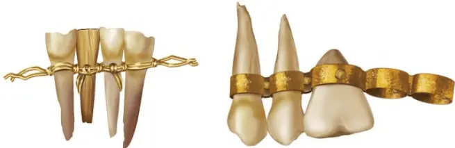 history of gold teeth