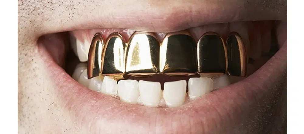 history of gold teeth