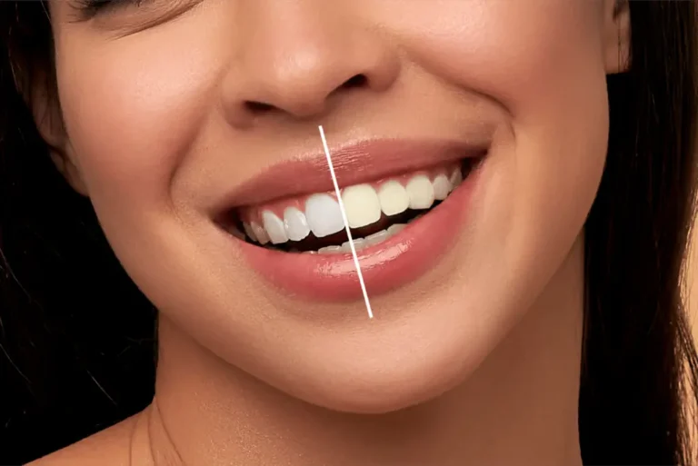 Teeth Whitening in Dubai