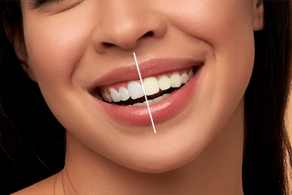Teeth Whitening in Dubai