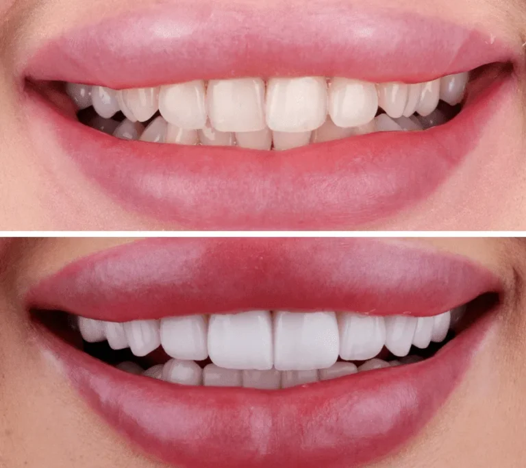 Best Veneers in Dubai