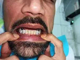 Fix Grillz in Dubai
