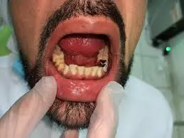 Fix Grillz in Dubai