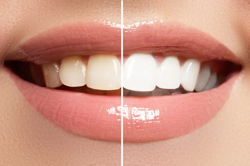 Teeth Whitening in Dubai