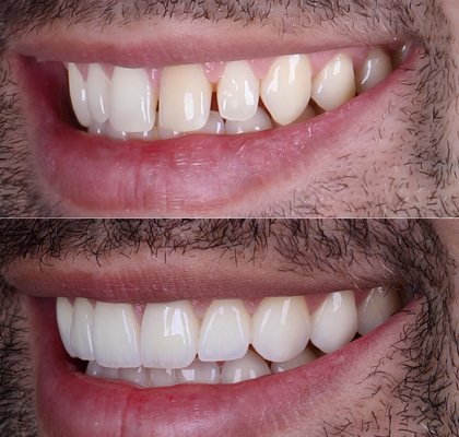 Best Veneers in Dubai