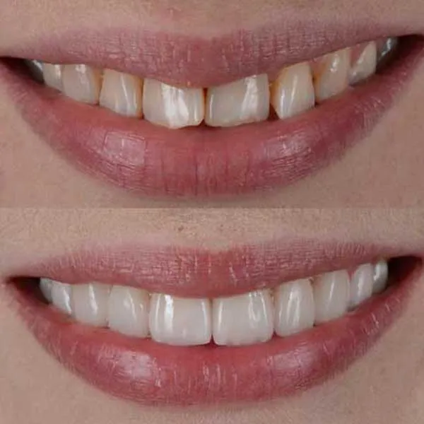 Best Veneers in Dubai