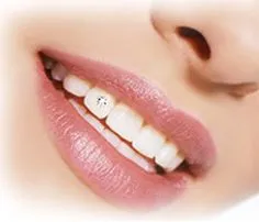 Diamond Dental Veneers
