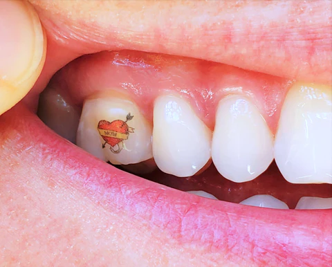 Permanent Teeth Tattoos