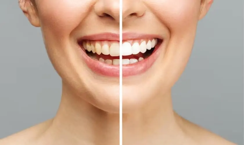 Professional Teeth Whitening