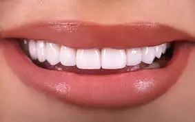 Veneers Clinic in Dubai