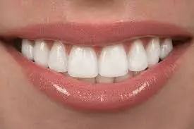 Veneers Clinic in Dubai