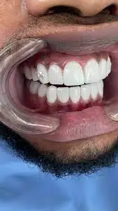 veneers with diamonds