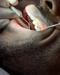 luxury diamond veneers