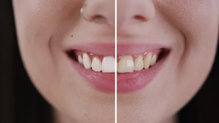 Professional Teeth Whitening