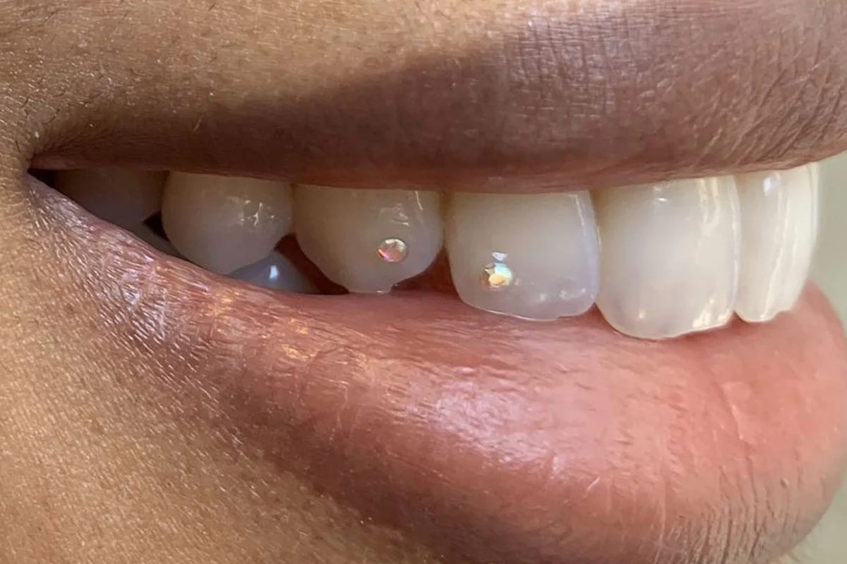 Best veneer dentist in Dubai