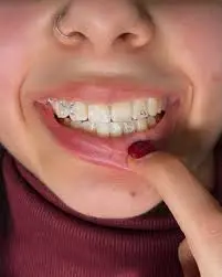 Luxury smile jewelry