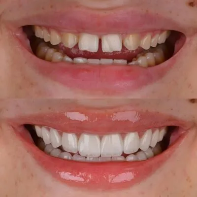 Veneer Treatment in Dubai