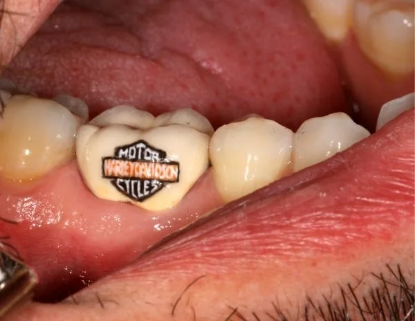 Custom Tooth Art