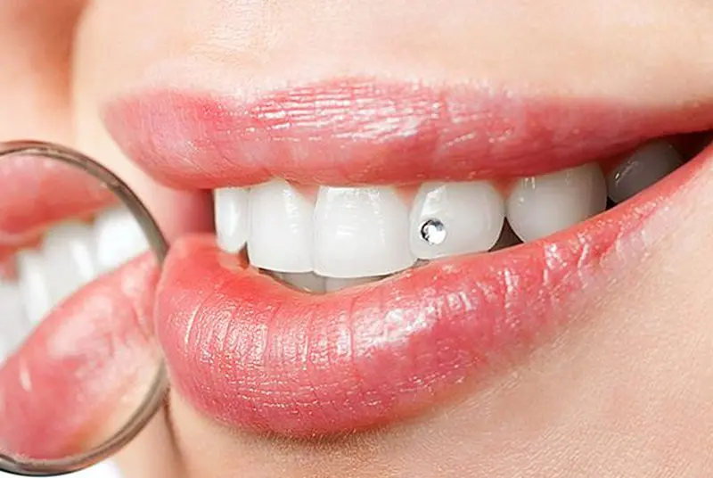 Best veneer dentist in Dubai