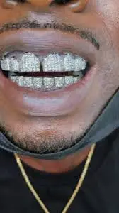 Custom Diamond Dental Veneers