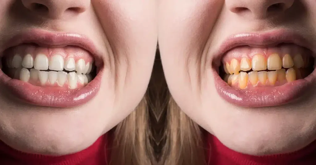 Teeth whitening treatment in Dubai