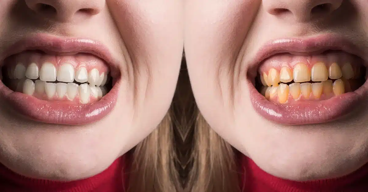 Teeth whitening treatment in Dubai