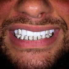 Custom Diamond Dental Veneers
