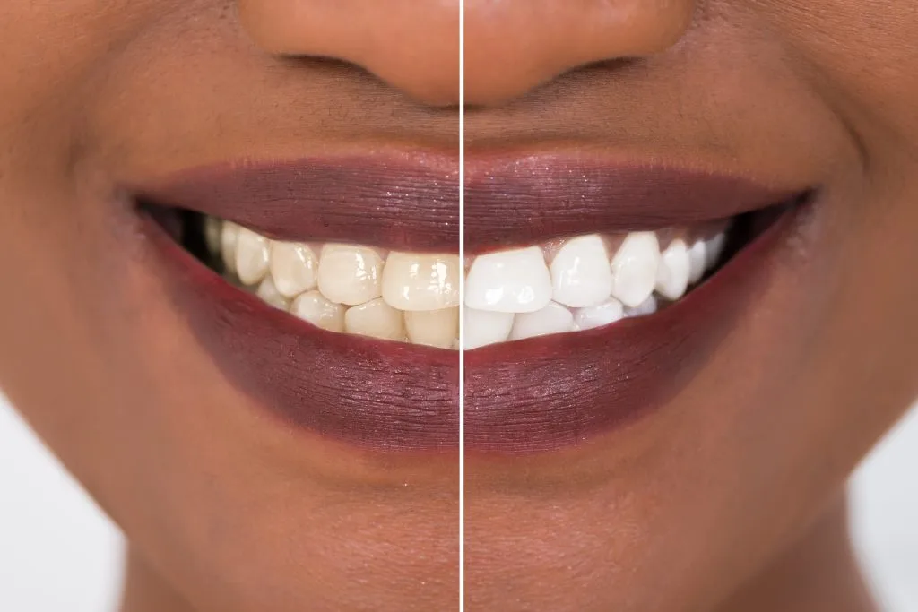 Teeth whitening treatment in Dubai