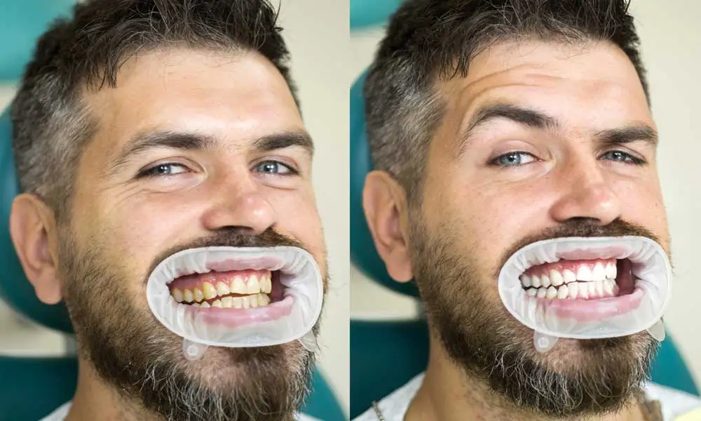 Teeth whitening treatment in Dubai