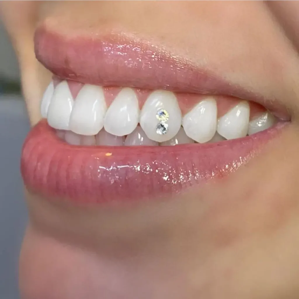 cosmetic diamond veneers