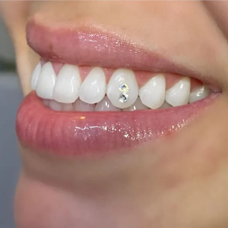 cosmetic diamond veneers