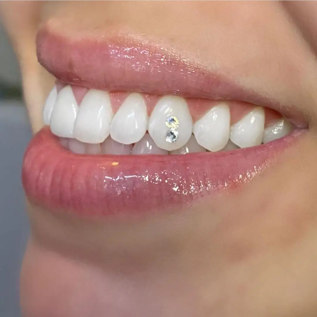 cosmetic diamond veneers