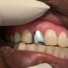 Cosmetic tooth designs
