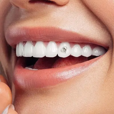 cosmetic diamond veneers