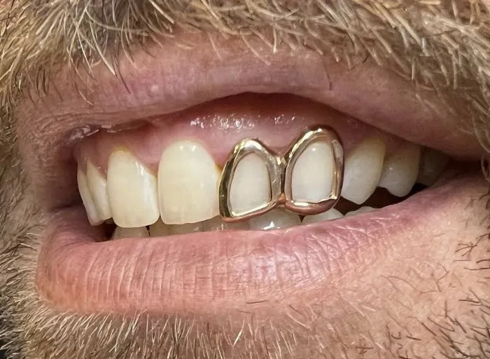 Removable Grillz