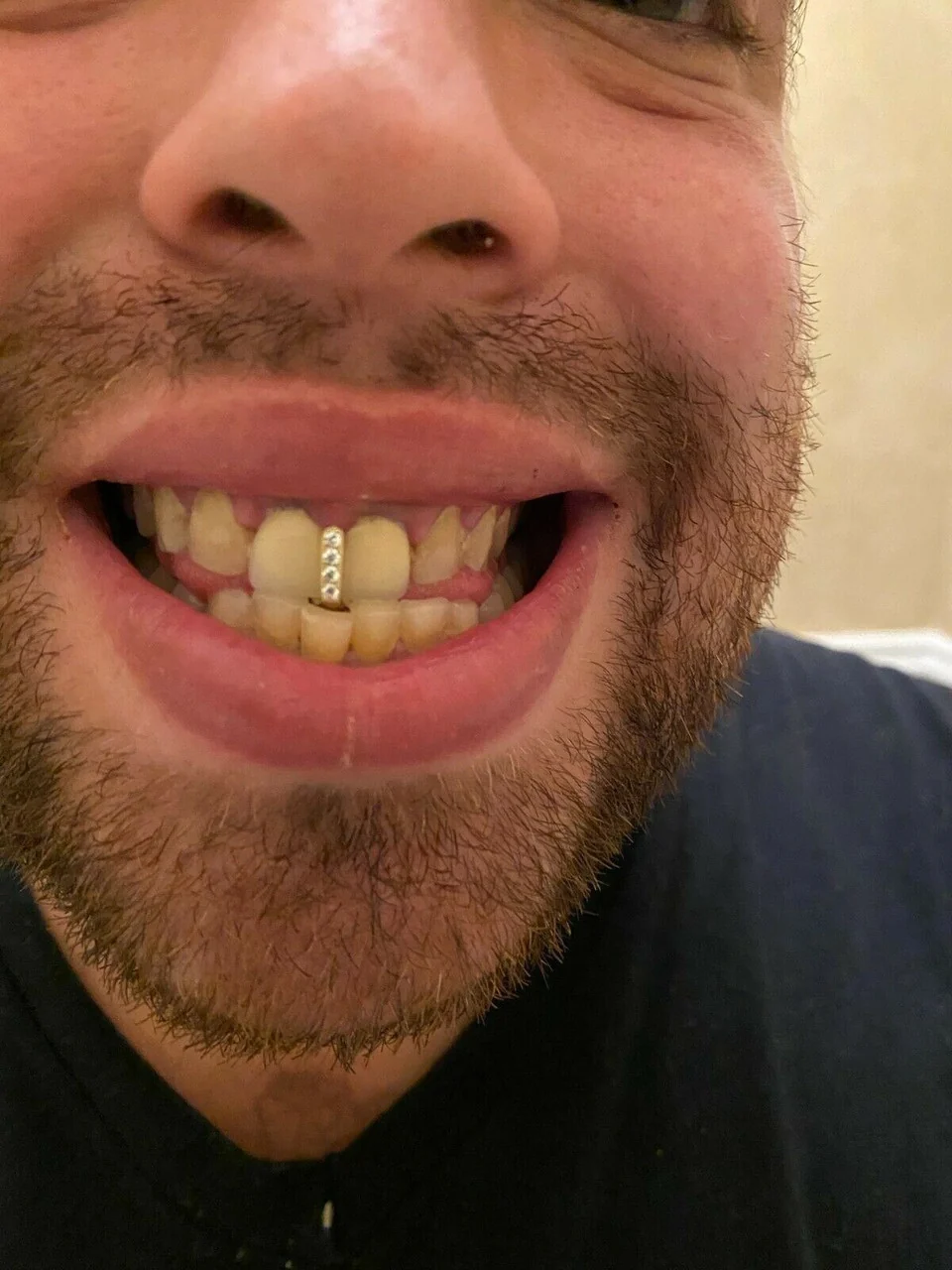 Grillz for Gap Teeth